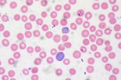 Merozoites (stained blue) can be seen inside red blood cells (pink). Photo by Ed Uthman.